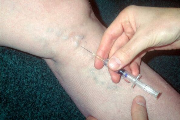 склеротерапија за проширене вене