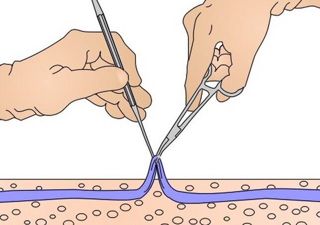 уклањање вена за проширене вене